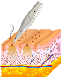 Aplicação clínica com Plexr Plus em região periocular